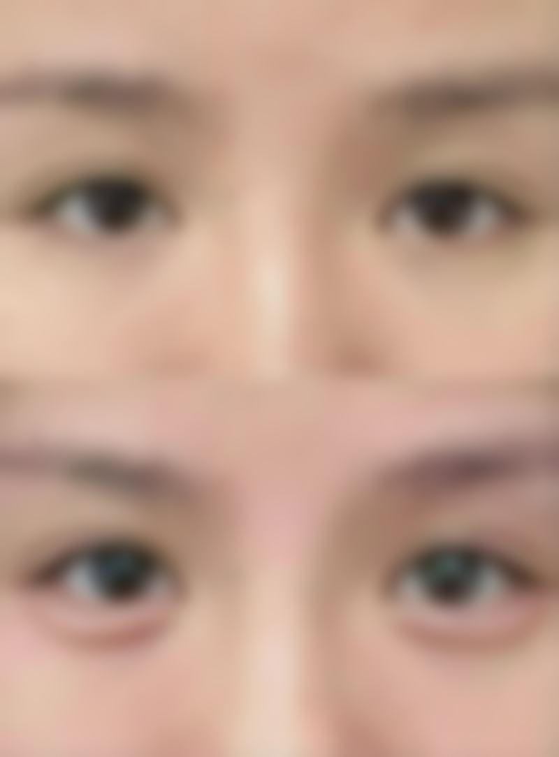 如何去缝针后的疤痕疙瘩:日常护理——预防胜于治疗