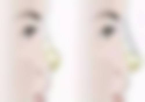 手术伤口疤痕增生用什么方法治疗:药物注射治疗,精细打击顽固