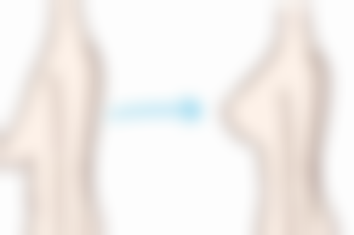 外切眼袋冰敷减轻肿胀的作用：告别“包子脸”，重现精致容颜