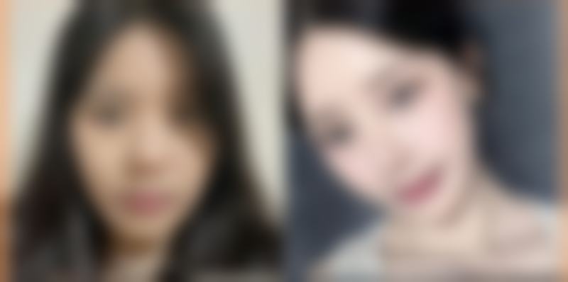 外切眼袋冰敷是起什么作用？消肿止痛+收缩血管，术后72小时黄金护理关键！