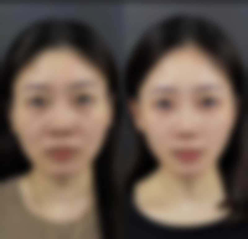 割双眼皮可以熬夜吗有影响眼部健康吗