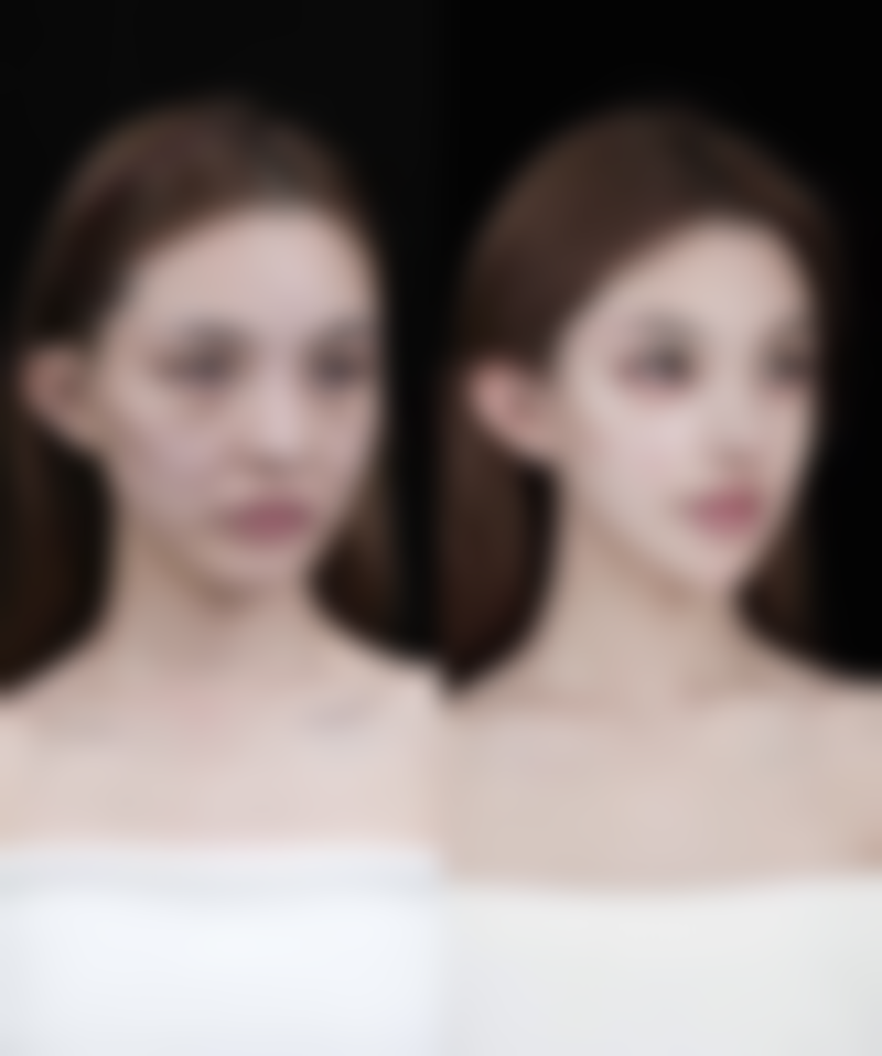 割双眼皮可以熬夜吗有影响双眼皮成效吗