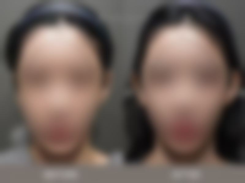 外切眼袋冰敷减少出血的作用：血管“临时交警”，保护修复顺畅