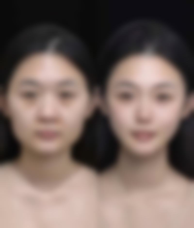 双眼皮算是整容吗？微整or大改，埋线无痕双眼皮真相大揭秘