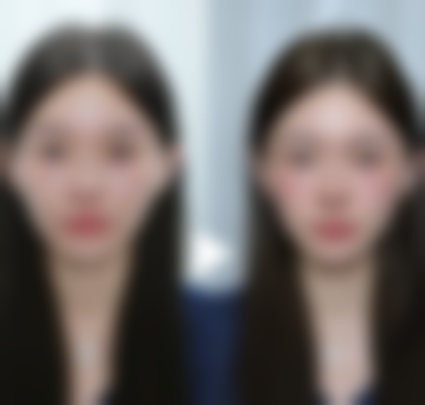 外切眼袋冰敷收缩血管的作用：低温“魔法”，控制出血水肿