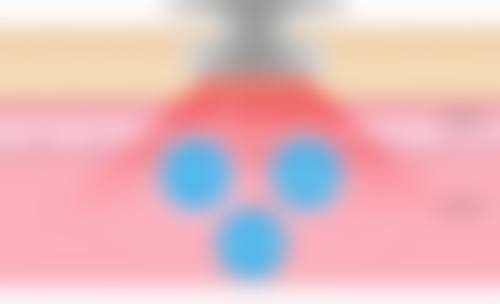 3岁小孩脸上烫伤疤痕慢慢能修复吗：烫伤深度决定修复难度