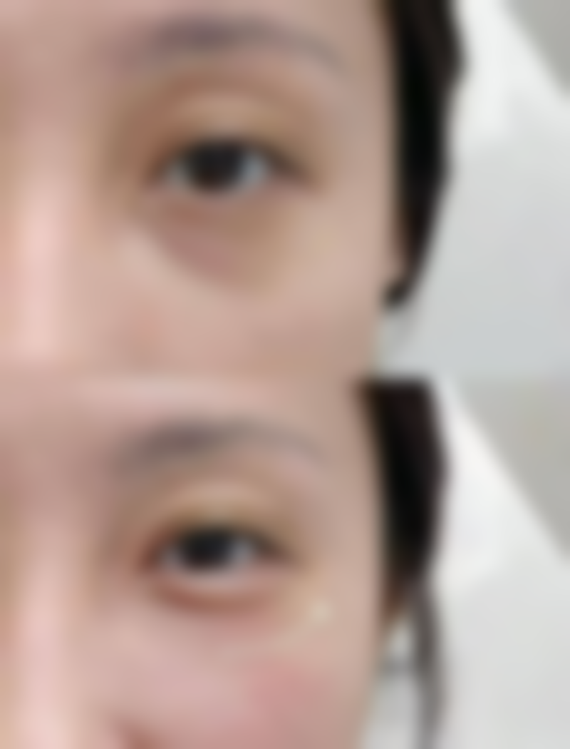 3岁小孩脸上凹陷疤痕慢慢能修复吗：小坑填平有方法