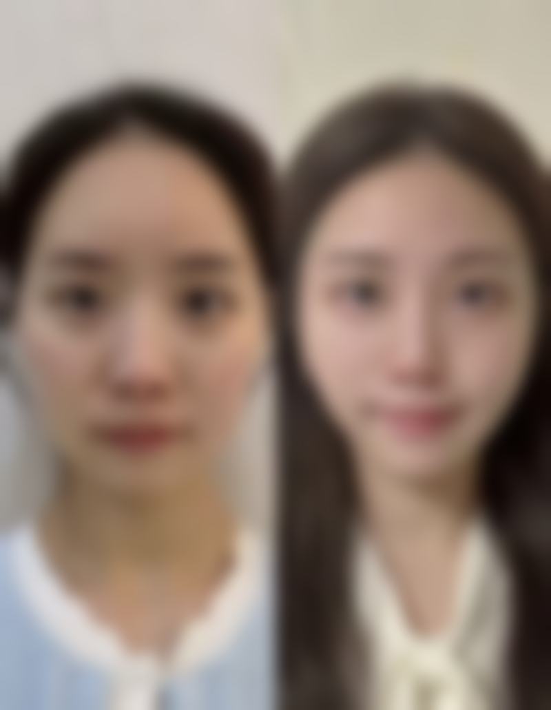 3岁小孩脸上陈旧性疤痕慢慢能修复吗：老疤也有新生希望