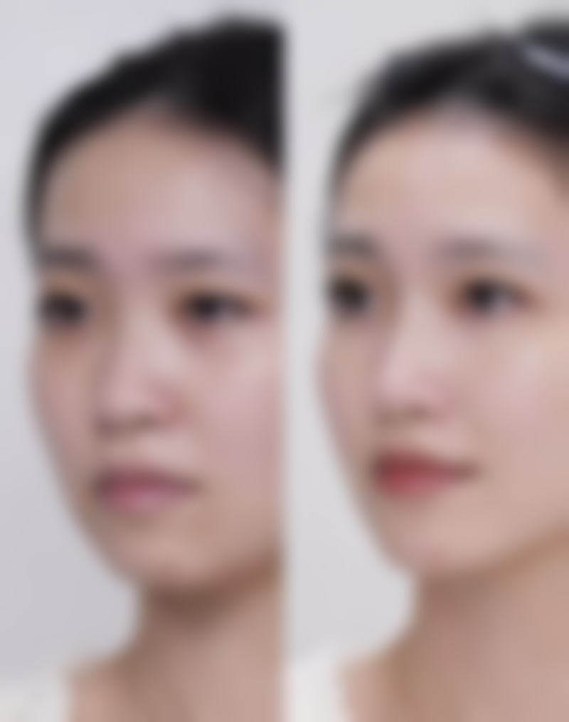 价格指南：割双眼皮和割眼袋打包价更划算吗？