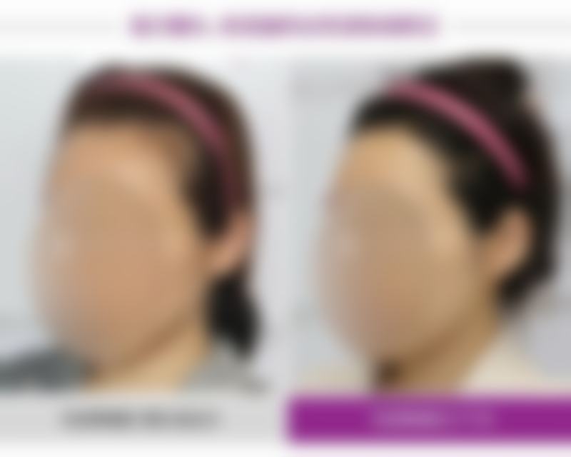 烫伤如何快速消除疤痕之治疗时间表规划