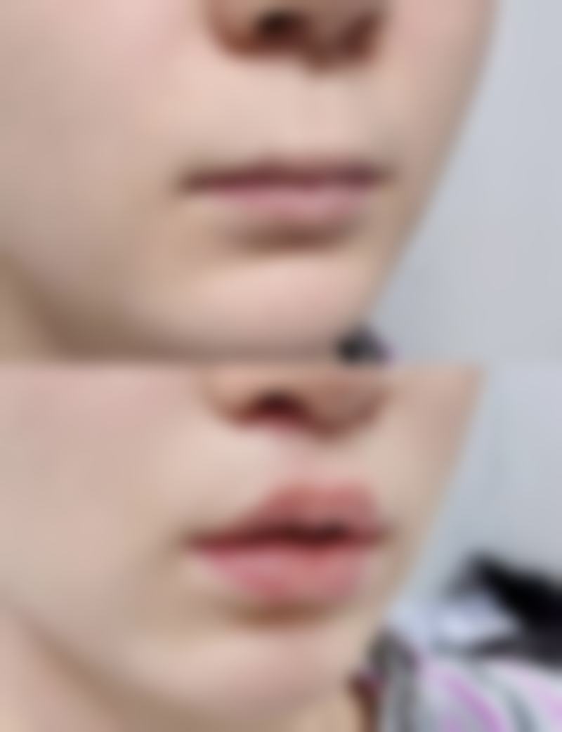 什么遗传因素属于疤痕皮肤