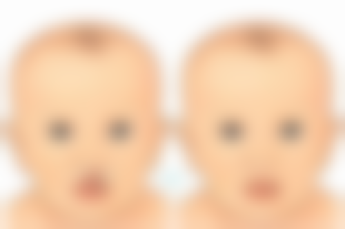 隆鼻硅胶膨体哪个好之术后成效PK