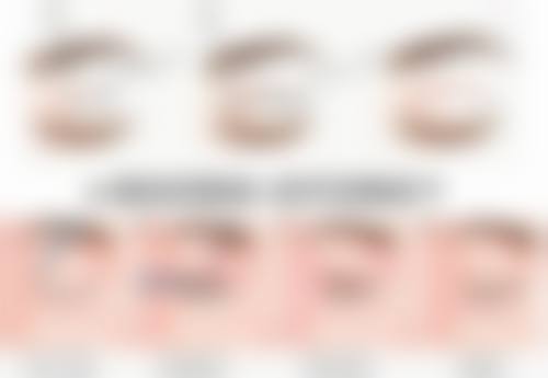 3种科学修复方法拯救嗨体打泪沟变成的眼袋危机