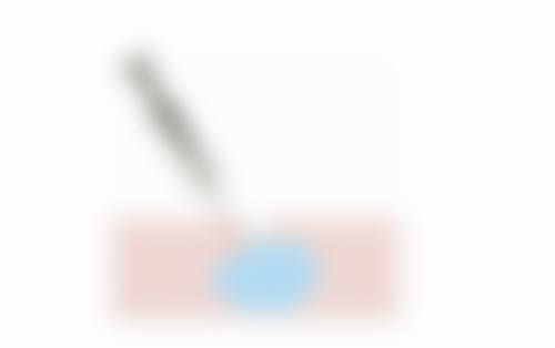 嗨体打泪沟变成眼袋怎么办？3种修复方法+预防措施全解析