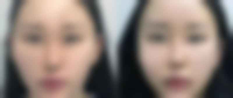 如何预防嗨体打泪沟变成眼袋的悲剧重演