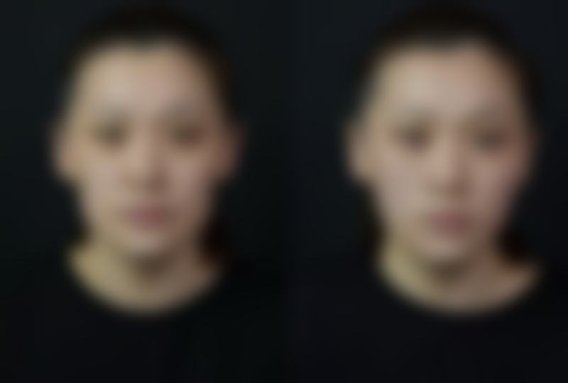 隆鼻硅胶膨体哪个好之术后护理指南