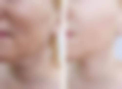 做了阴道紧缩术修复多久能同床：完整修复期2 - 3个月