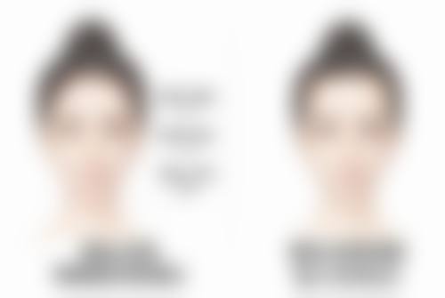 如何才能消掉疤痕体质之手术治疗——完全解决大型疤痕难题