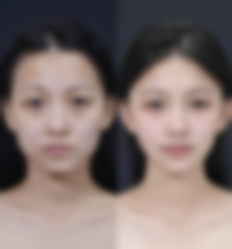 影响瘦脸针多久可以出成效的因素：深度剖析