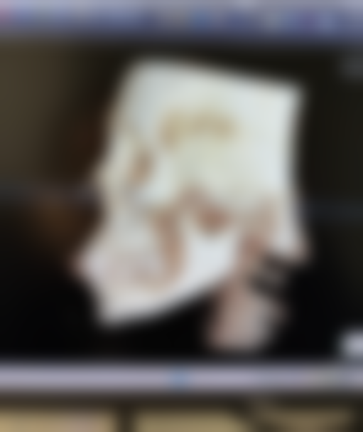 如何才能消掉疤痕体质之激光治疗——高新科技重塑肌肤光彩