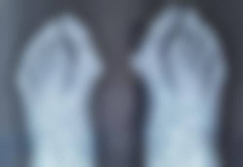 20年的疤痕怎么消除？激光手术双管齐下，烧伤妊娠疤也能淡化