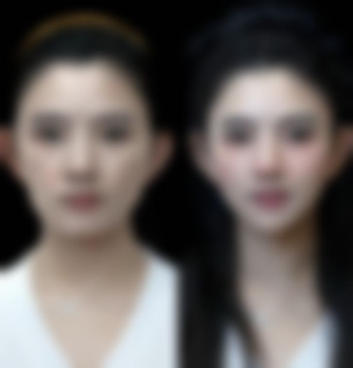 双眼皮下垂怎么做:术后护理,手术成功的关键