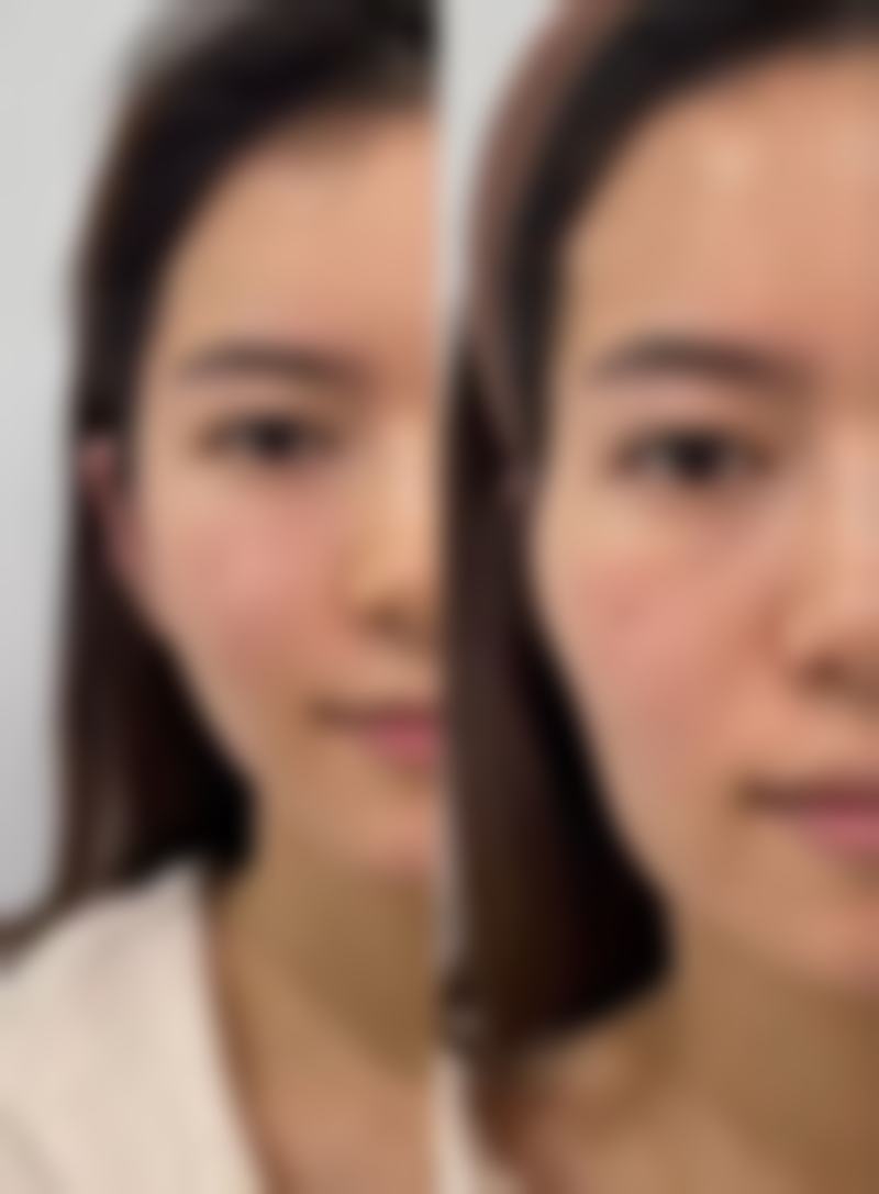 抽脂填胸有什么副作用——脂肪液化问题解析