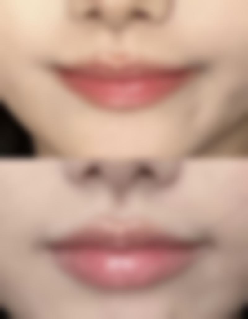 20年的手术疤痕怎么消除:医院精细修复重塑美观