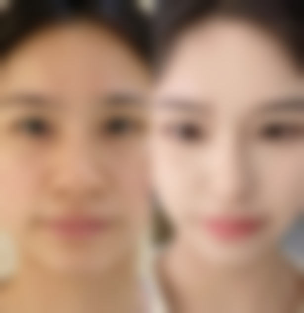 20年的色素疤痕怎么消除:医院专精方案淡化色素