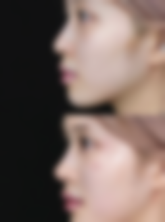 双眼皮手术拆线多久可以碰水之加速修复 buff