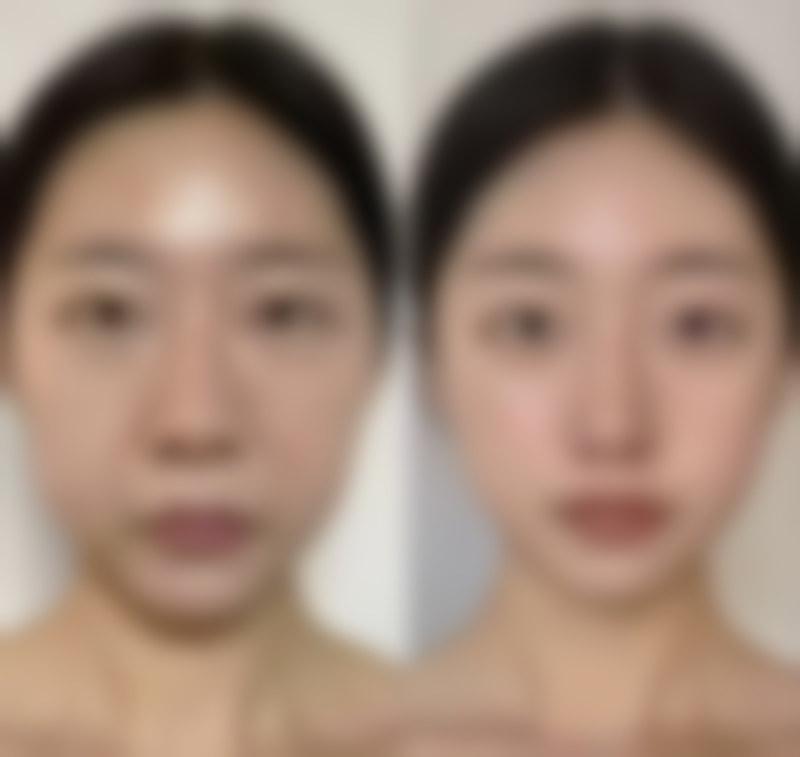 双眼皮手术拆线多久可以碰水之灵魂拷问