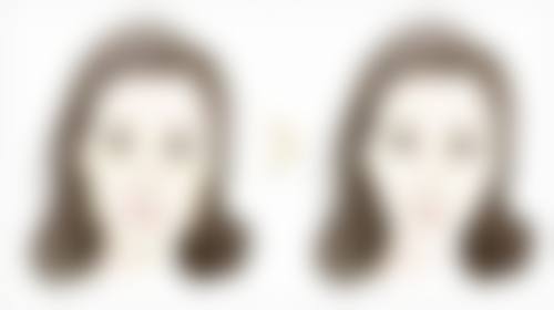 面部青春痘疤痕怎么治疗——手术治疗：重度疤痕的“终极解决方案”