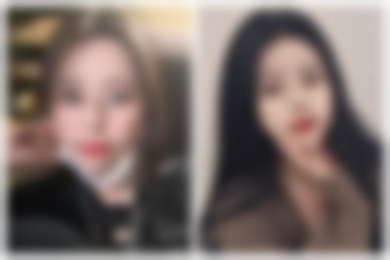 面部青春痘疤痕怎么治疗？点阵激光+医用祛疤膏双管齐下告别痘坑