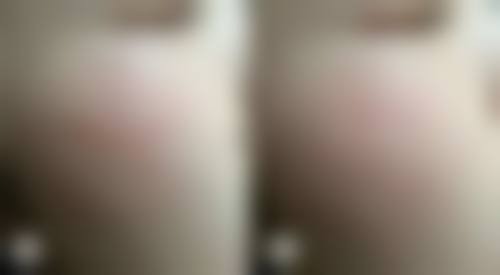 为什么疤痕愈合后会痒？神经再生+炎症反应揭秘，手术烫伤疤痕必看！