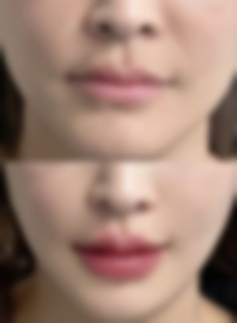 疤痕疙瘩怎么修复较好？权威医院推荐+激光/药物联合疗法大公开