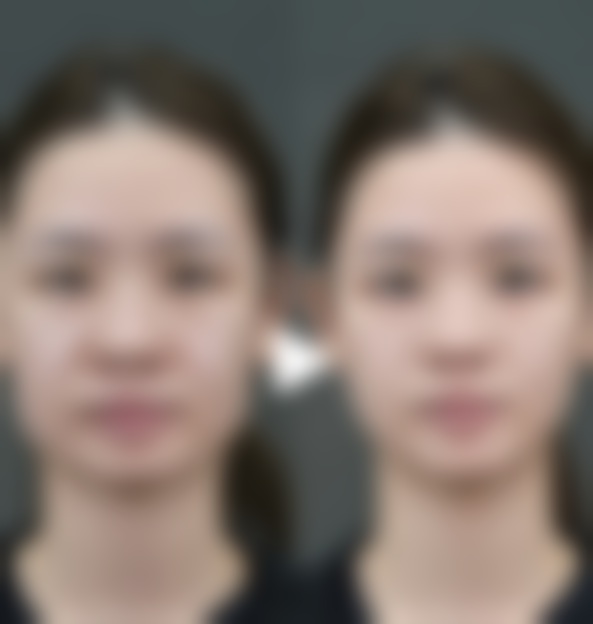 为什么疤痕愈合后会痒:皮肤干燥加剧瘙痒难题