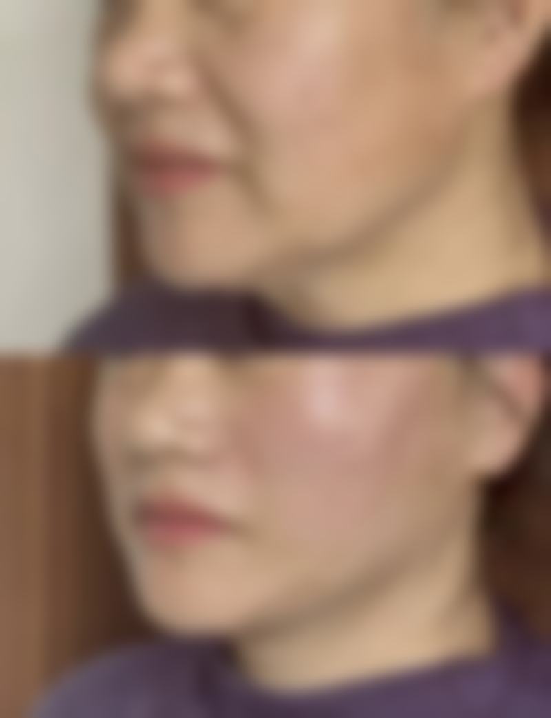 硅胶隆胸能喂奶吗？术后哺乳安全指南+假体护理要点解析