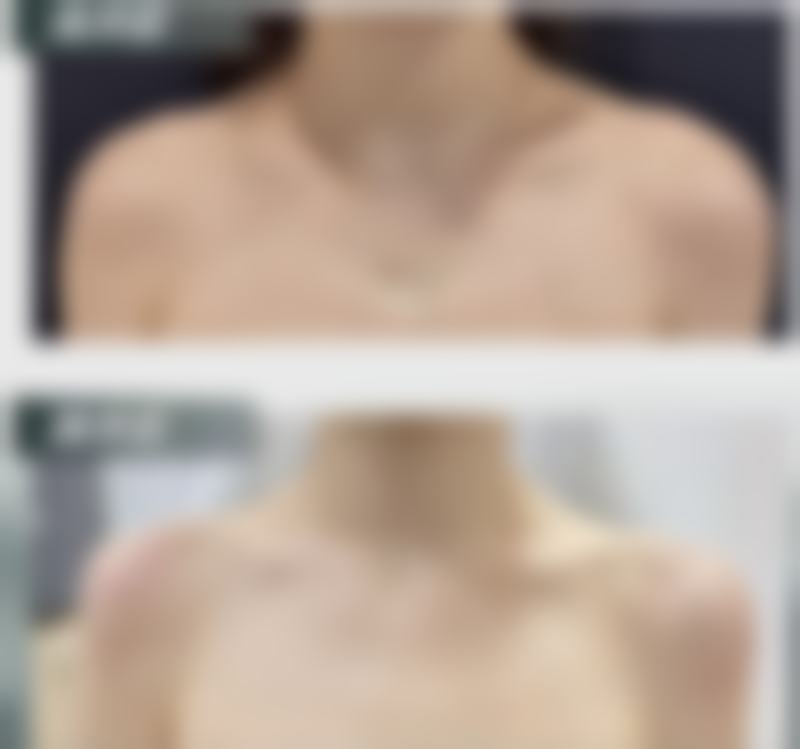 割了双眼皮肿得厉害，日常护理的“要”与“不要”需谨记