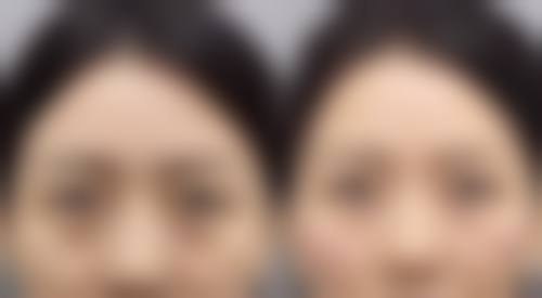 红色凹陷疤痕怎么消除：食疗消除之吃出来的美丽肌肤