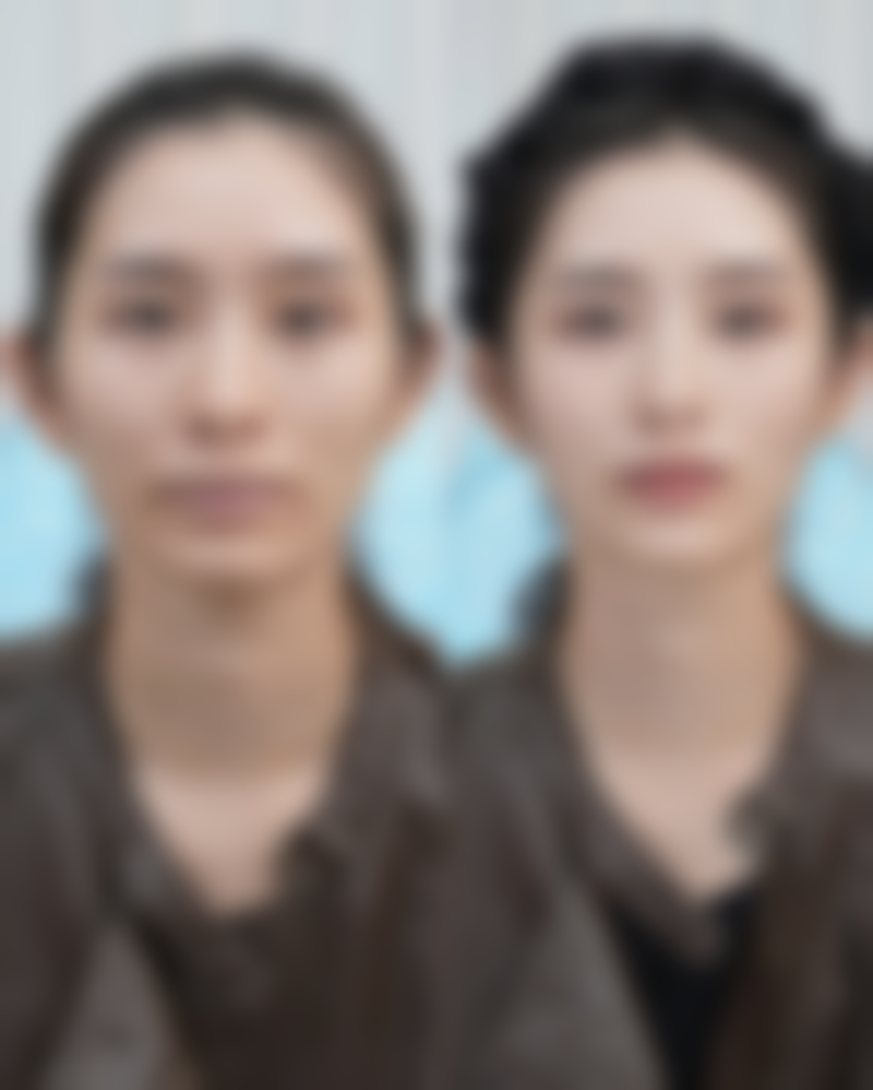 指甲抠的手部疤痕怎么去除