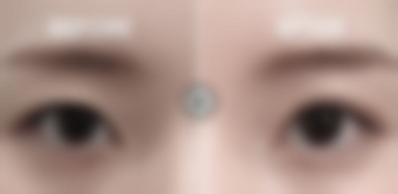 自体隆鼻可以恒久吗？恒久成效的潜在影响因素