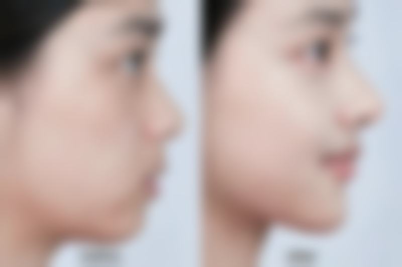 怎么知道自己天生是双眼皮：从自然特征判断