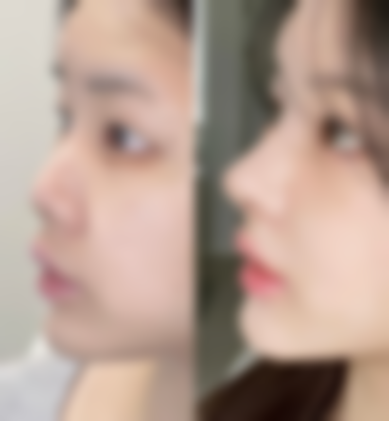 加速疤痕黑印自然淡化的生活小妙招