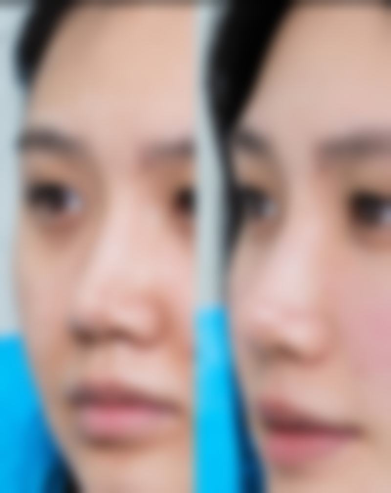 疤痕黑印自然淡化与体质因素的关联