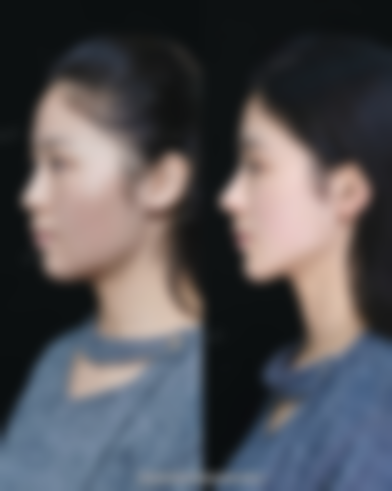 做假体隆胸:术后护理不可忽视