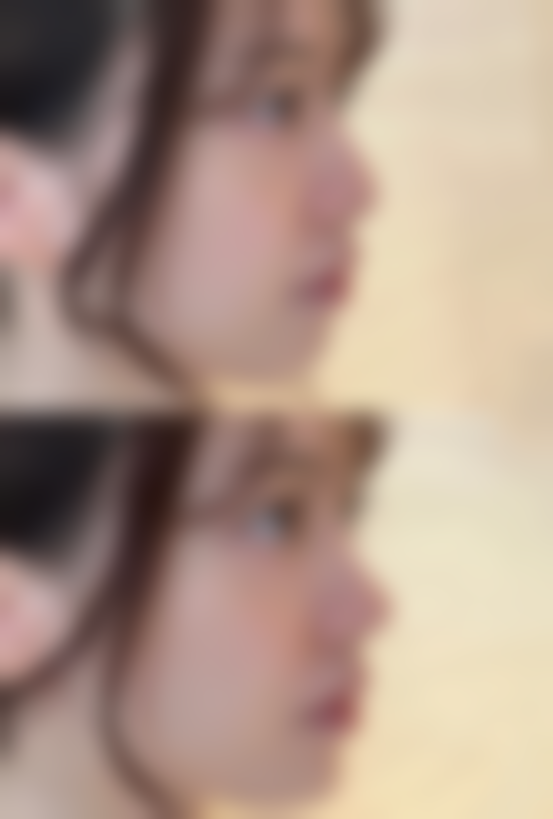 自体脂肪隆胸多久可以第二次——填充需求：小修小补和大刀阔斧的区别