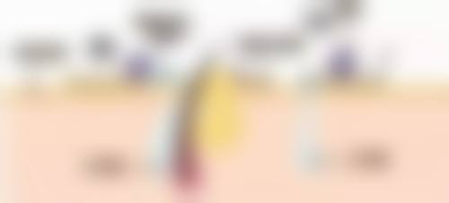 割双眼皮后眼睛闭不上怎么办：5步修复指南