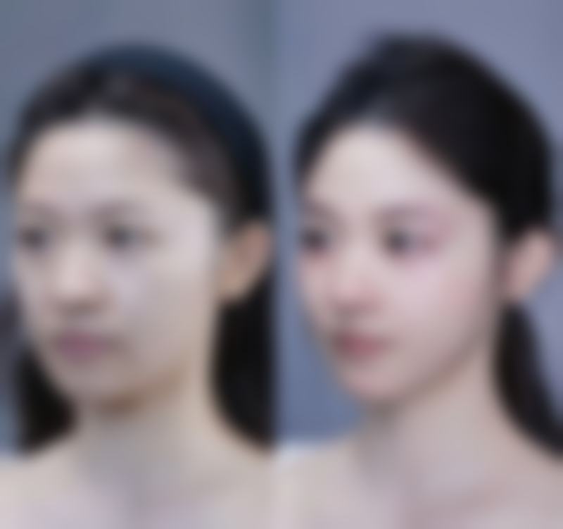 曼托假体隆胸术后修复需要多长时间？护理指南