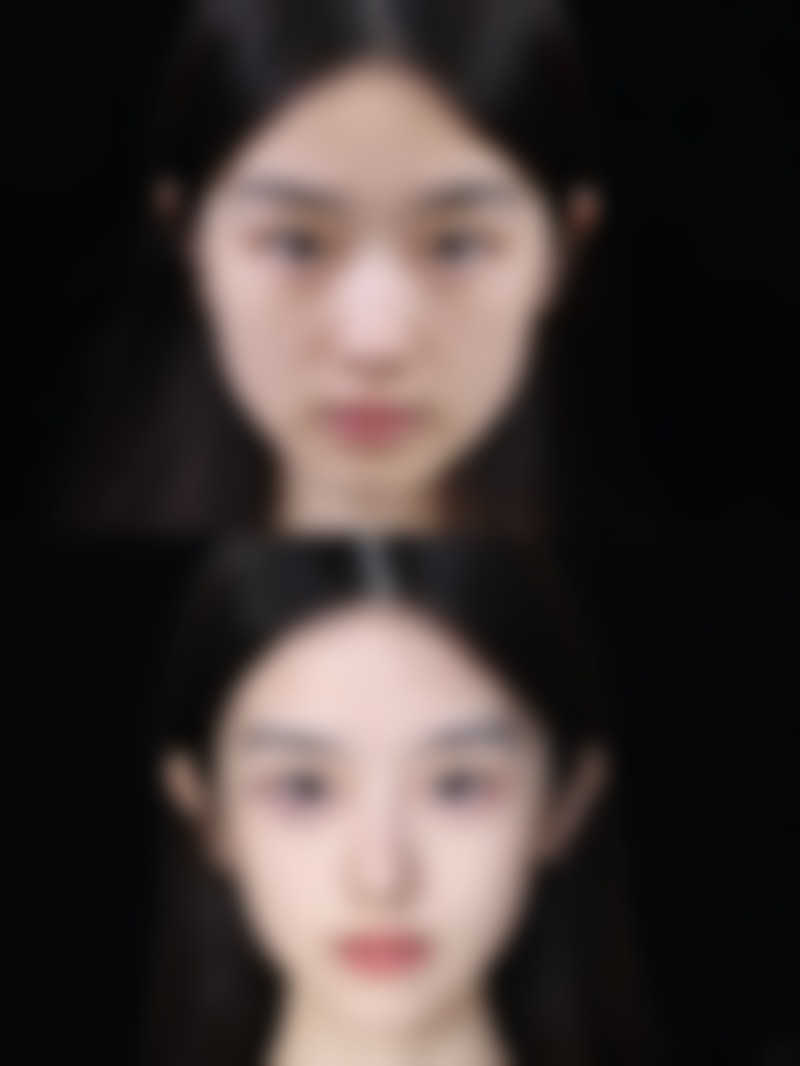 维持时间延长秘籍：让隆胸脂肪填充成效更持久