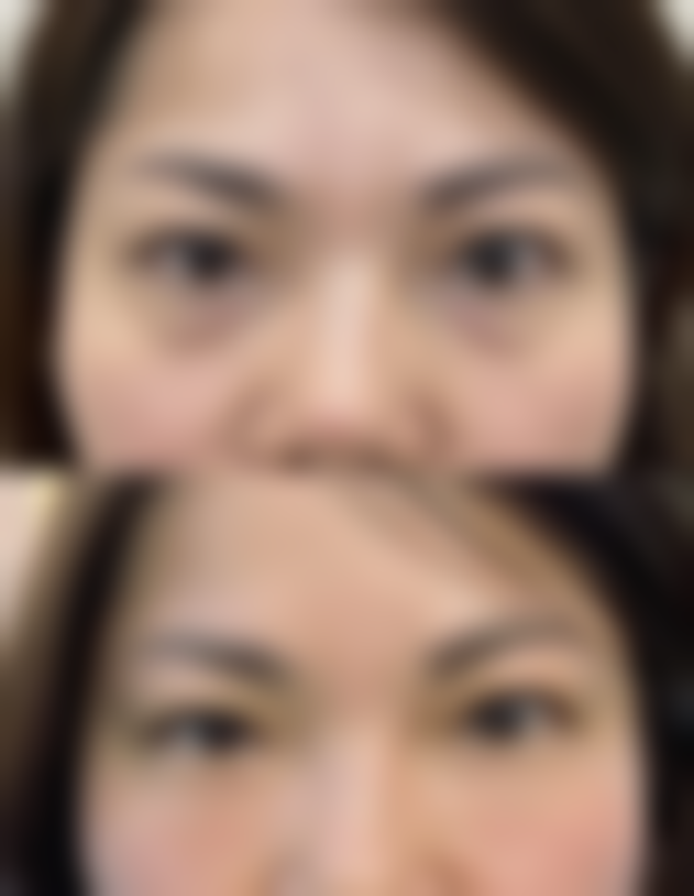 不同地区医院：隆胸脂肪填充的差异与特色